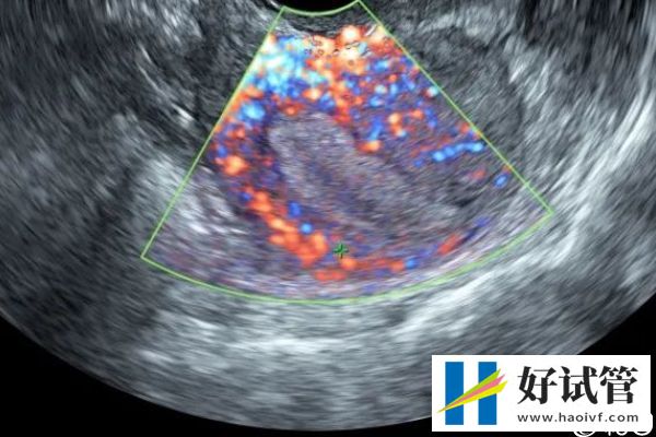 试管移植冻胚前针灸埋线的功效真不少,帮助着床只是其一(图3) 试管移植冻胚前针灸埋线的功效真不少,帮助着床只是其一(图3)
